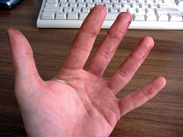 rankos trecia diena po dazymo